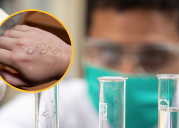 Primo caso di vaiolo delle scimmie riscontrato a Malta